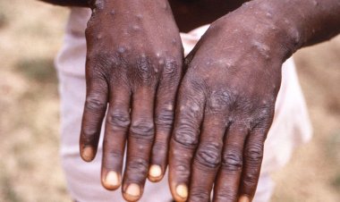 Brasileiro tem 1º caso de varíola dos macacos registrado na Alemanha