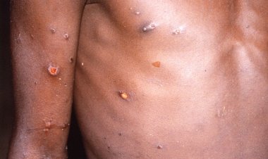 Saúde monitora dois casos suspeitos de varíola dos macacos