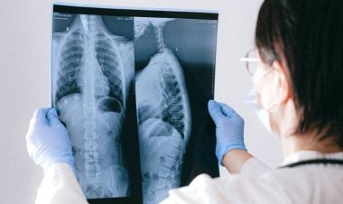 Tuberculose tem cura e tratamento garantido pelo SUS